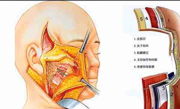 拉皮手术是什么？怎么做？优缺点？